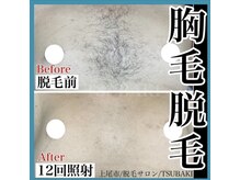 ツバキ(TSUBAKI)/メンズ胸脱毛