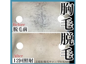 ツバキ(TSUBAKI)/メンズ胸脱毛