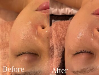 アティレ オオサカ(Attirer Osaka)/毛穴ケア黒ずみくすみハリツヤ