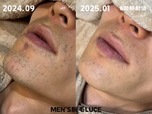 ルーチェ/【ヒゲ脱毛】夜の髭剃りのみ