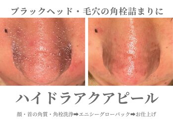 エクラ イオンモール徳島店(ECLAT)/ハイドラアクアピール+CO2パック