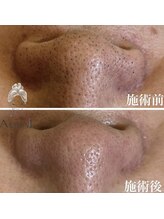 エアリアル 大川店/いちご鼻気になりませんか？