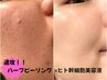 速攻効果体験◎【繰り返す肌荒れ・ニキビケア】ハーブピーリング＋ヒト幹導入