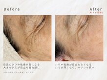 メレ(mele)/60代シミしわ／ニキビケア・毛穴