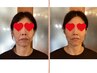  笑顔の印象を明るくしたい。口角・フェイスラインが気になるあなたへ。 
