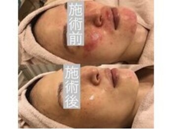 トータルサロンアイビーシー(トータルサロンIBC)/希少機械!プラズマゼノデュアル