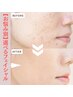 選べるフェイシャル☆BBL光＋オプション２つ☆90分/¥17,500(会)¥15,800