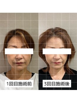 ヴィーライン 大阪梅田院(VeLine)/鍼灸／美容鍼／小顔／大阪／梅田