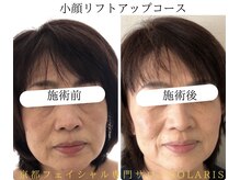 ソラリス(solaris)/小顔リフトアップコース