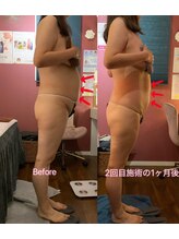 レイ 本厚木(Rei)/脂肪冷却お腹のビフォーアフター