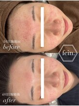 フェイン 青山店(fein.) 肌質改善 ピーリング