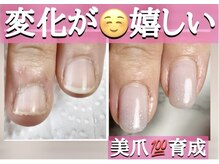 スターネイル(Starnail)/噛み爪むしり癖から美爪さんへ