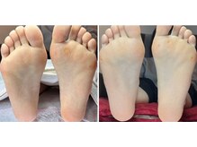 巻爪レスキュー 尼崎/角質除去