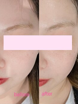 ドルチェナッツ ネオ 府内店(dolce nuts NEO)/ララピール＋新世代ヒーライト♪