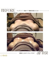 グランツ 小山店/術後インディバ　術後ケア　