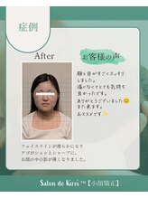 小顔矯正専門サロン　Salon de Kirei　【たるみ改善/リフトアップ/博多】/After