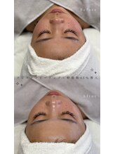 メルリー(Meruly)/ラレステン×幹細胞45%導入