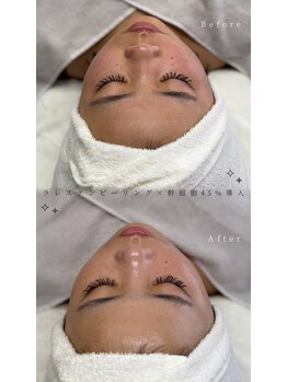 メルリー(Meruly)/ラレステン×幹細胞45%導入