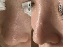 ウル 下北沢(Ulu)/ハーブピーリング19回