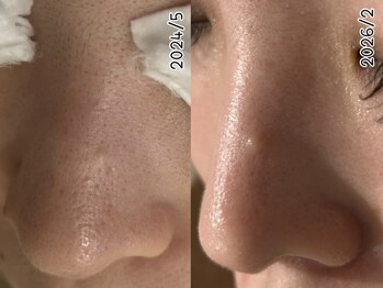 ウル 下北沢(Ulu)/ハーブピーリング19回