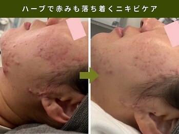 アンテサロン 関内店(Antesalon)/ハーブピーリングBefore&After