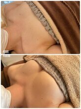ベルビューティー(belle beauty)/【サイズアップ/C以下】症例写真