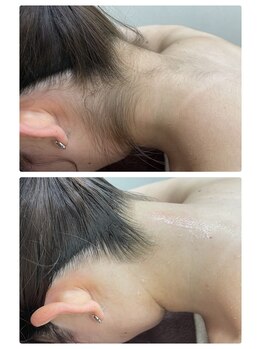 アルストロメリア(Alstroemeria)/全身脱毛（うなじ脱毛込み）