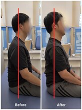 とばた整骨院/顎関節矯正後姿勢変化