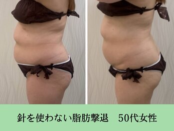 ソルニス(Solnis.)/痩身☆脂肪分解/ハイパーナイフ