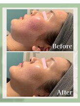 リボンサロン(Ri.bon Salon)/ハーブピーリング（剥離なし）