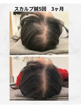 ココハリ/スカルプ鍼5回目