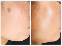 Beauty salon CENDRILLON【サンドリヨン】/肌質改善