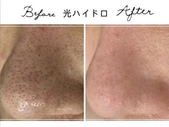 アリュール 倉敷(ALLURE)の写真/通いやすい価格No.1◇黒ずみ/開き/ザラつき【強力洗浄】取れない黒ずみも一気にツルツル《平日割￥6,500》