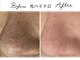 アリュール 倉敷(ALLURE)の写真/通いやすい価格No.1◇黒ずみ/開き/ザラつき【強力洗浄】取れない黒ずみも一気にツルツル《平日割￥6,500》