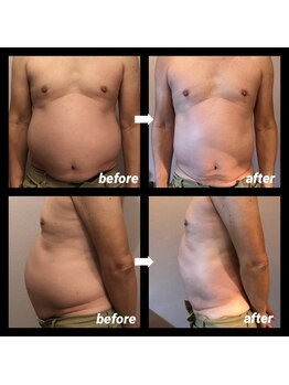 伊達男/フォースカッター事例