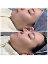 ピュア 川越店/光フェイシャル＋小顔美容液