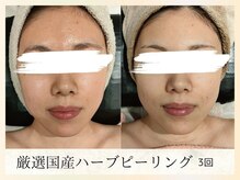 ソウナ(SONA)/ハーブピーリング