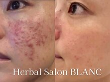 ブラン 名古屋高岳(BLANC)