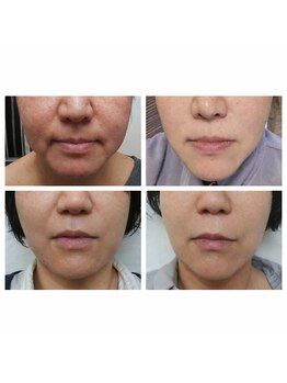 サロンルーチェ(Salon Luce)/珪素トリートメント