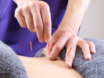 東武練馬鍼灸整体院シマ(shima)/鍼施術風景1