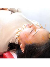 よつば鍼灸整骨院 春日院/美容鍼