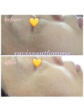 ラヴィソンファム(Ravissant femme)/40代1回効果/シミ改善