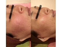 ビューティースパ/ホワイトスノーピール赤ら顔改善