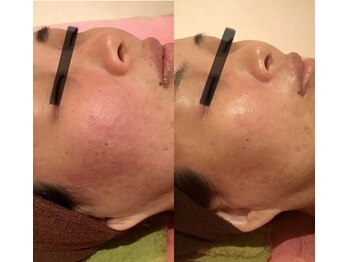 ビューティースパ/ホワイトスノーピール赤ら顔改善