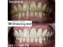 ホワイトニングバー 福島店/6回コース終了ビフォーアフター