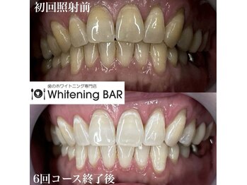 ホワイトニングバー 福島店/6回コース終了ビフォーアフター