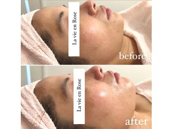 ラヴィアンローズ 忠節店(La vie en Rose)/水光ピーリング before→after