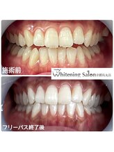 ホワイトニングサロン 京都烏丸店/ホワイトニング施術例