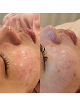 レイネイル レイエステティック 岐阜茜部店(RAY NAIL & RAY ESTHETIC)/赤みが出る方にもオススメ