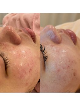レイネイル レイエステティック 岐阜茜部店(RAY NAIL & RAY ESTHETIC)/赤みが出る方にもオススメ